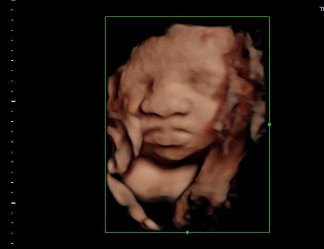 3D ultrasound image at 29 weeks